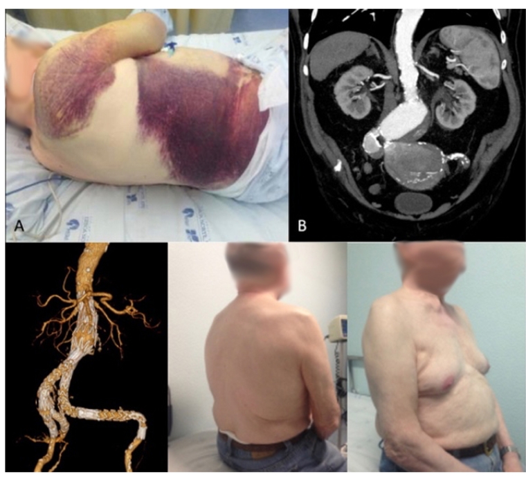 Abdominal aortic aneurysms how to treat in today s practice